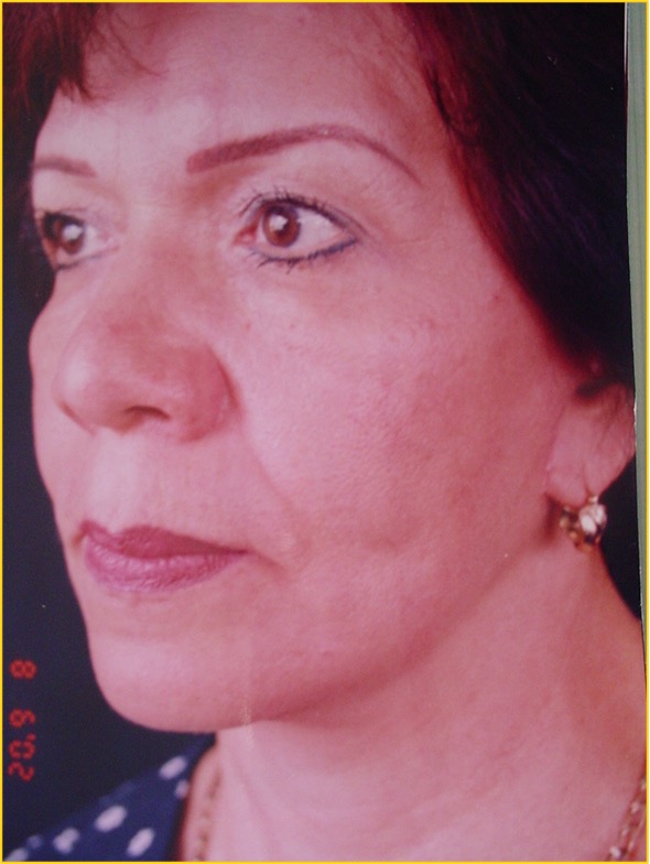 Después del procedimiento estético