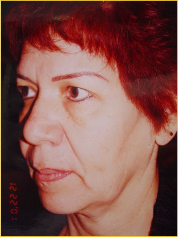 Antes del procedimiento estético